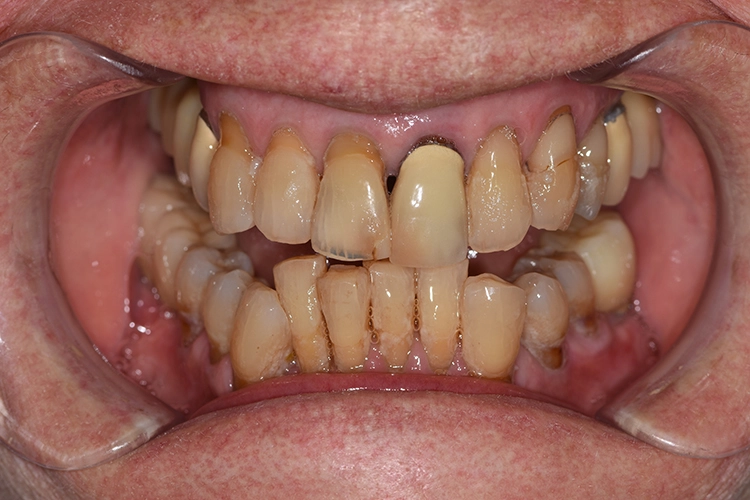 Abb. 3: Intraorale Situation einer 100-jährigen Patientin mit weitgehend stabilen parodontalen Verhältnissen: Die Patientin hatte 3 gesunde Implantate, ST im Mittel 1,44 mm, CAL im Mittel 3,33 mm, CPI Grad 3. Als Diagnose wurde eine moderate Parodontitis festgestellt.