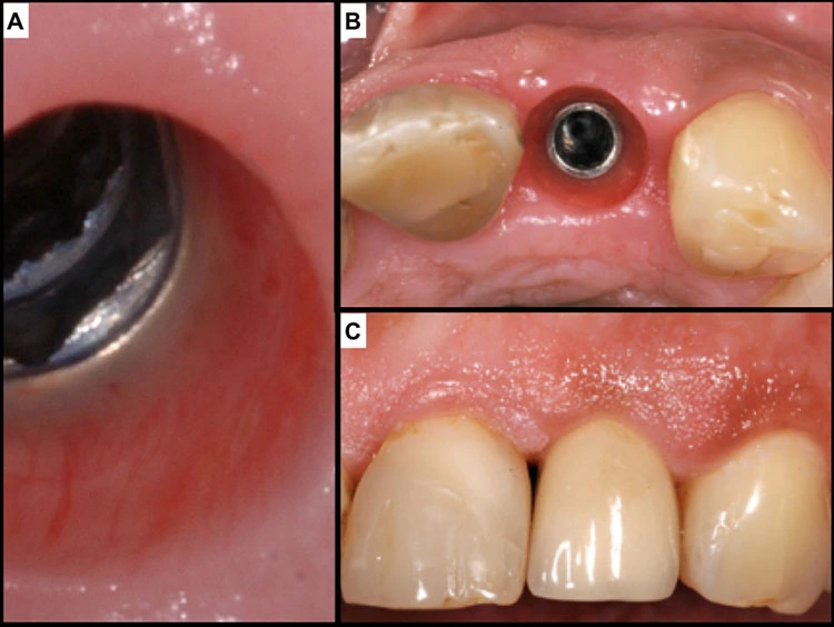 Abb. 3: Weichgewebekragen bei einem Implantat: Gerade bei tief gesetzten Implantaten (wie im ästhetischen Bereich oftmals der Fall) ist die Gesunderhaltung der Gewebe und die optimale Ausformung eine Herausforderung (A/B). In vielen Fällen bleibt der Interdentalraum nur unvollständig ausgeformt (C).