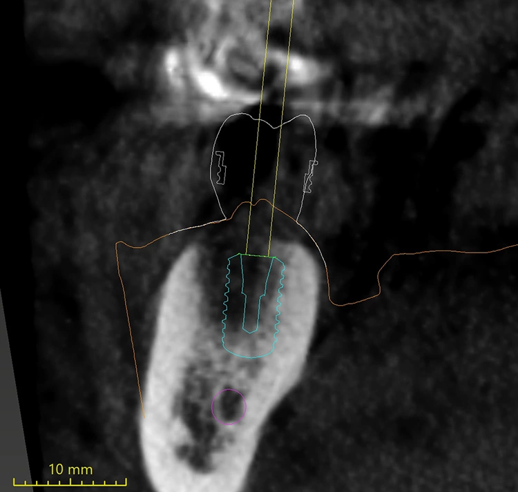 Abb. 3: Auszug aus der digitalen Implantatplanung der Versorgung. Markierung des N. alveolaris inferior