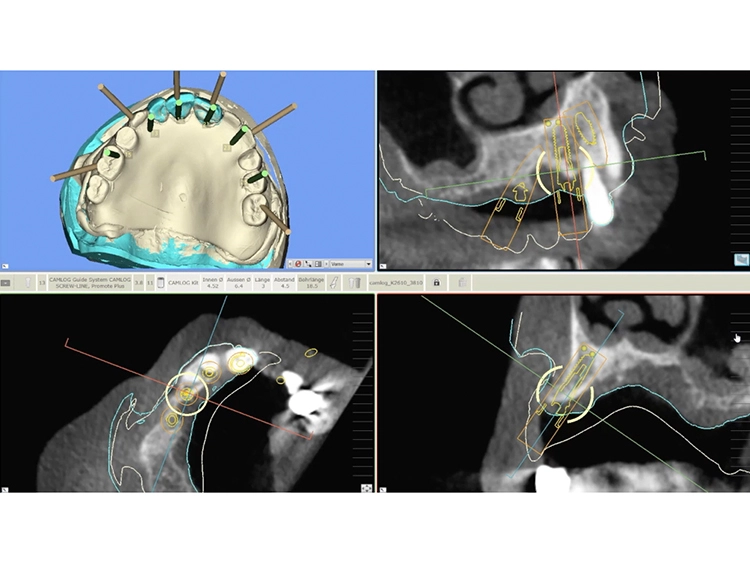 Abb. 3: Planung der Implantatpositionen.