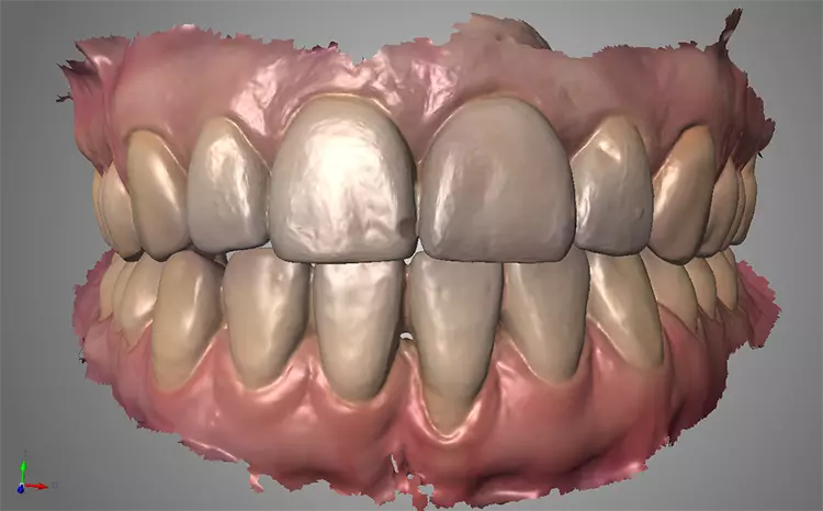 Abb. 3: Ausgangssituation als virtueller Datensatz in der Intraoralscanner-Software.