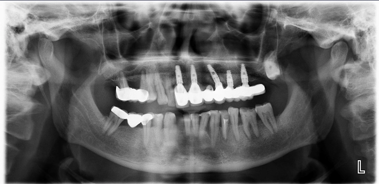 Abb. 3–6: Der Vergleich von nativem Röntgenbild (am Beispiel von OPG und Bissflügelaufnahme verschiedener Patienten) und dem Bild mit eingeblendeten Detektionen zeigt die Gründlichkeit der KI-Befundung. Die befundeten apikalen Läsionen sind orangefarben markiert, die Karies rot. Bestehende Versorgungen sind blau und türkis hervorgehoben. Die Zahnsituation ist so für den Patienten im Gespräch gut nachvollziehbar und auch in der Nachbereitung zuhause immer wieder gut zu erkennen.