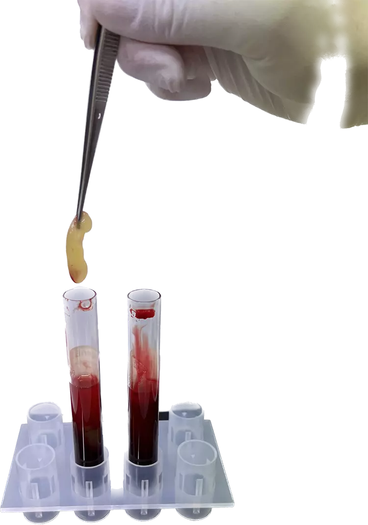 Abb. 3: Entnahme eines L-PRF Clots
aus einem Glasröhrchen nach der Zentrifugation,
mit einer Pinzette.