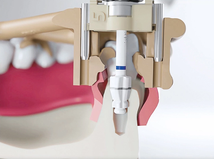Abb. 3: Bei der Bohrung, Stanzung oder Insertion mithilfe des SDS BOX FULL NAVIGATION SYSTEM, welches auf Schienen „2ingis“-Systems basiert, wird nicht über eine zentrale metallische Bohrhülse, sondern über zwei laterale Führungshülsen geführt, welche wiederum in zwei Führungsarmen befestigt unmittelbar mit dem Winkelstück verbunden sind. Dies garantiert eine sehr präzise, kontaminationsfreie Insertion unter direkter Sicht auf das OP-Gebiet.