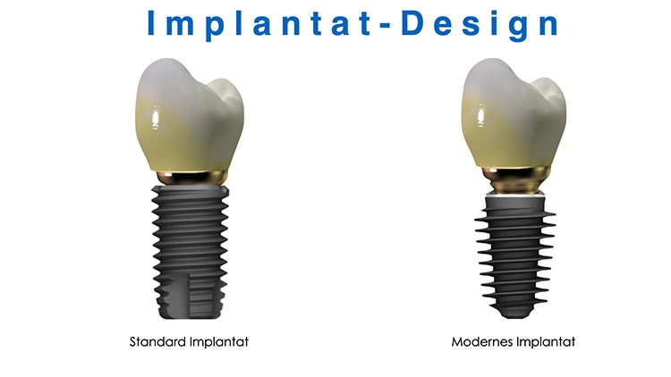 Abb. 3a: Implantattypen im Vergleich.