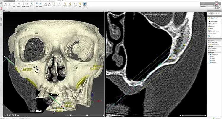 Abb. 4: Planung der Zygoma-Implantat-Insertion in Navigations-Software nach CT-DICOM Daten.