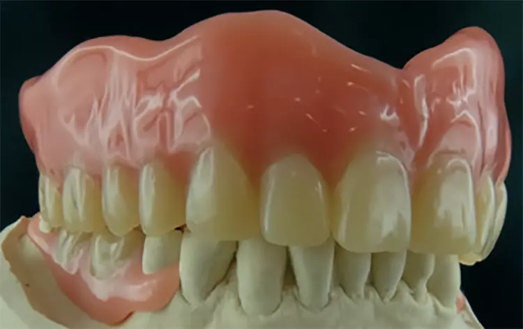 Abb. 47: Funktionelle, ästhetische Totalprothese. Wobei der Vorteil von individuell gefrästen Zähnen bei der optimal einzustellenden Okklusion liegt. Auf der linken Seite wurde aufgrund der ungleichmäßigen Kauebene auf einen bukkalen Kontakt bei 35 verzichtet.