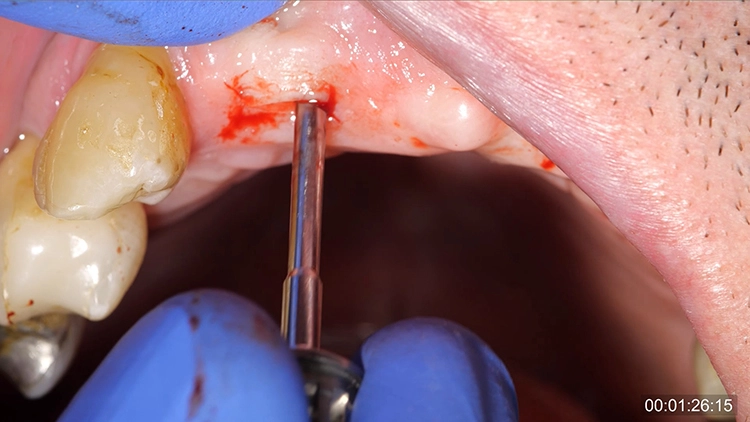 Abb. 4: Minimalinvasive Freilegung nach Bone Split.