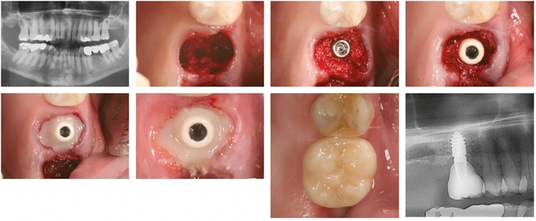 Abb. 4a-h: Sofortimplantat regio 16 Champions (R)Evolution ø 4,5 mm – Länge 8 mm) mit internem, direkten Sinuslift (IDS). Die Alveole wurde mit Knochenersatzmaterial aufgefüllt, welches nach dem Smart-Grinder Verfahren aus dem extrahierten Zahn des Patienten gewonnen wurde.