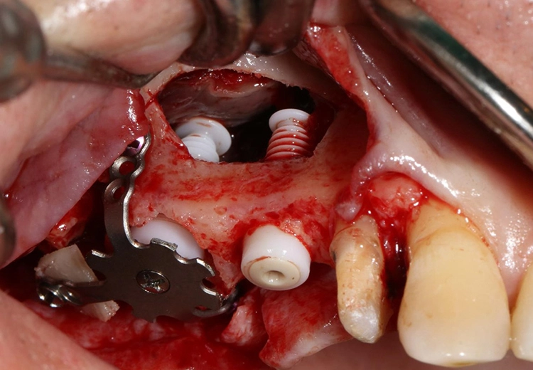 Abb. 4: Intraoperative Darstellung nach Sinusbodenelevation, Implantatinsertion und Anpassung des dynamischen Titangitters.
