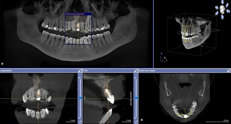 Abb. 4: Planung der Implantatposition regio 21 anhand des dreidimensionalen Bildes (DVT).