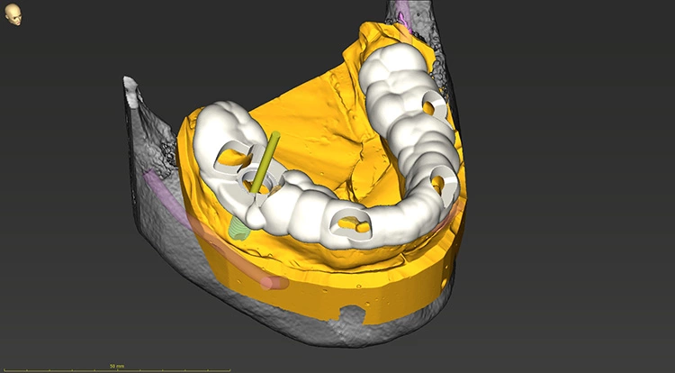 Abb. 4: Screenshot aus der digitalen Planungssoftware CoDiagnostiX (Dental Wings); hiermit erfolgte die prothetisch ausgerichtete Implantatplanung 046 sowie die Planung der Bohrschablone auf der Basis der DVT und des Modellscans.