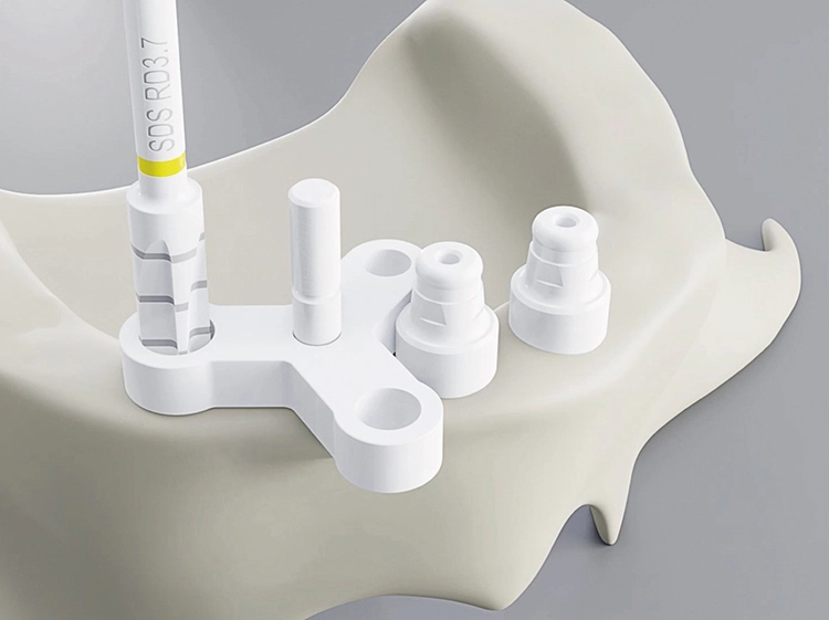 Abb. 4: Das ad-hoc Navigationssystem „AIM - ANATOMICAL IMPLANTATION METHOD“ von SDS ermöglicht es, mit ausschließlich vollkeramischen Komponenten selbst bei einem unbezahnten Kiefer ohne vorherige Planung schnell und präzise
die perfekte Bohrposition zu ermitteln. Als Referenz dient in einem solchen Fall der Canals Incisivus bzw. die zuvor gesetzten Implantate, um die weiteren Implantate senkrecht zur Gesichtsachse, parallel im perfekten Abstand zueinander und
symmetrisch auf gleicher Höhe zu setzen.