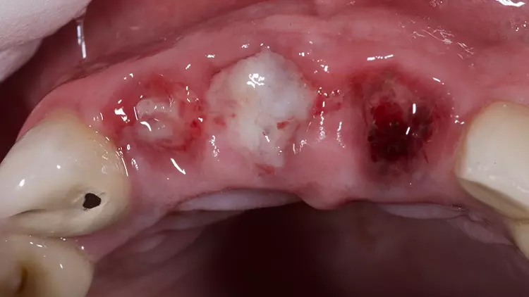 Abb. 4: Mit L-PRF Clots aufgefüllte Alveolen am zweiten postoperativen Tag.