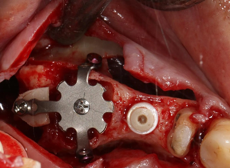 Abb. 5: Befestigung des dynamischen Titangitters am Knochen und am Implantat.