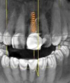 Abb. 5: Planung der Sofortimplantation mit BLX-Implantat.