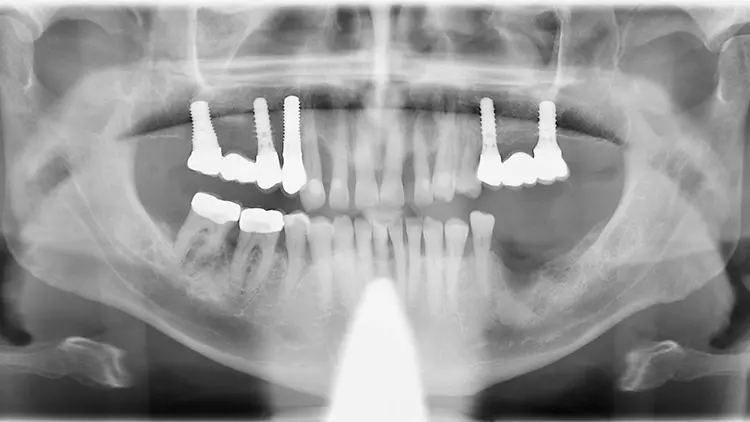 Abb. 5: OPG eines Patienten vor Beginn der Therapie einer Parodontitis. Beachte
die vertikalen Einbrüche mesial 22 bis fast zum Apex und den vertikalen Einbruch
mesial an Zahn 13.