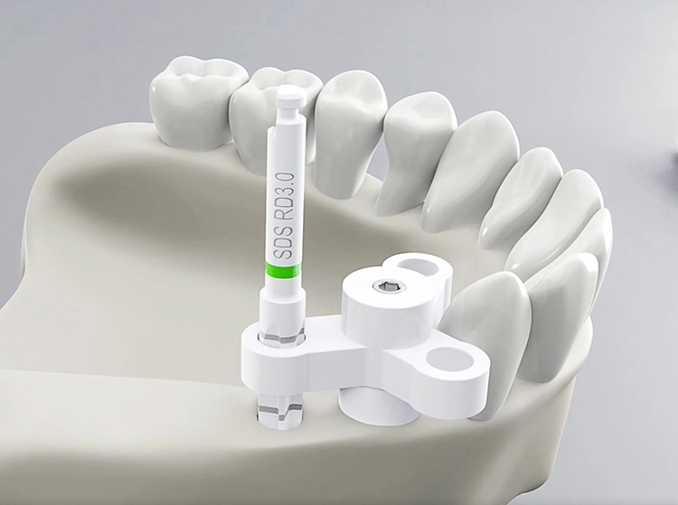 Abb. 5: Auch für Freiend- und Schaltlücken lassen sich mithilfe der sogenannten „Y“-Teile (abgebildet), die an die jeweilige Restzahnsituation angepasst sind, die metallfreien SDS Bohrer in die gewünschte Position intraoperativ bringen. Alle
weiteren Komponenten des kompletten AIM-Sets (wie Blume pder Depth Gauge), die in direkten Knochenkontakt kommen, sind ebenfalls aus sterilisierbarer, reiner Zirkonoxidkeramik – ebenso wie die SDS Bohrer und Implantate.