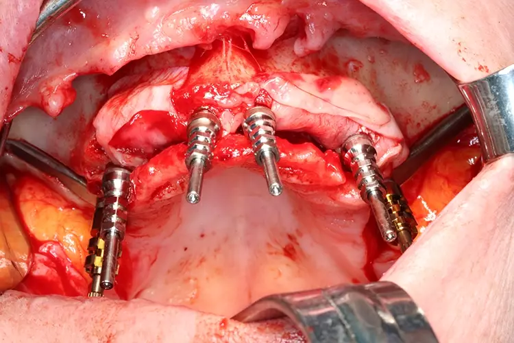Abb. 6: OP, Ansicht nach Positionierung der Implantate, buccal fat pad Päparation
und vestibulärer Aufbau mit Bio Oss/sticky bone, BioGide und A-PRF Membranen.