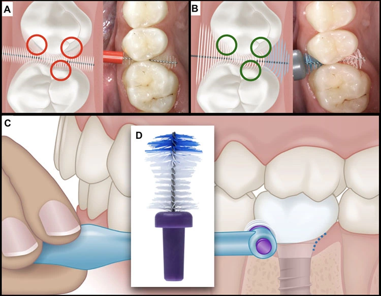 Abb. 6: Die Reinigungseffizienz von Interdentalraumbürsten wird durch die Form und Zugänglichkeit beeinflusst. Zylindrische Bürsten haben je nach Durchmesser gewisse Defizite bezüglich der Reinigbarkeit (A), während anatomisch angepasste Bürstenköpfe – zum Beispiel mit einem taillierten Design – auch schwierig zugängliche Stellen reinigen und auch bei größeren Kopfdurchmessern eine bessere Durchgängigkeit aufweisen. Besonders bei Implantaten können solche Konzepte hilfreich sein.