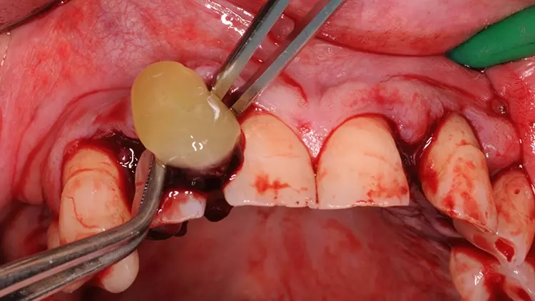 Abb. 7: Offene Parodontalchirurgie an Zahn 13 mesial und Applikation eines
L-PRF Clots.