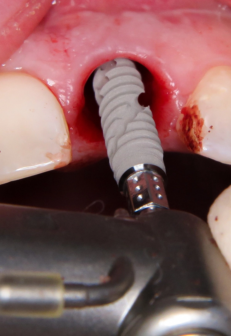 Abb. 7: Insertion des Implantats (Straumann BLX ø 4 mm, 14 mm).