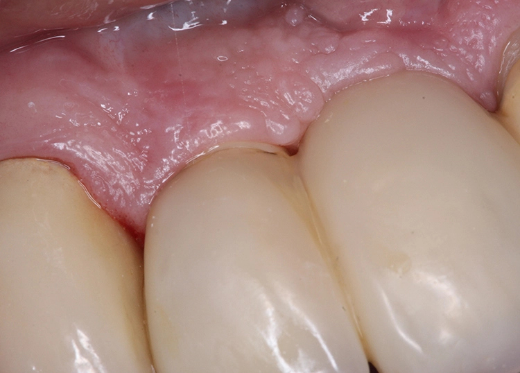 Abb. 7: Straffe Gewebeanlagerung im Bereich der Implantatdurchtrittsstelle.