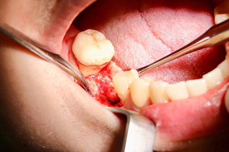 Abb. 8: Eröffnung des Implantationsgebietes in regio 46.