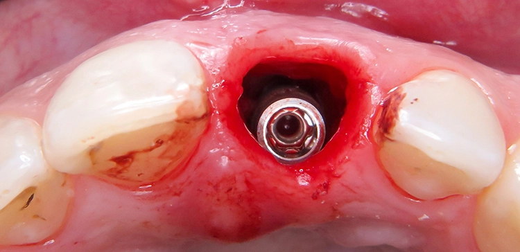 Abb. 8: Palatinal orientierte Position des inserierten Implantats.