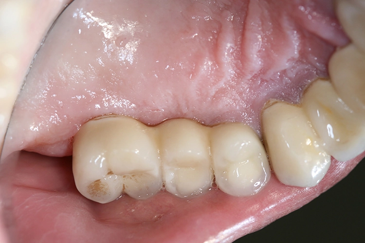 Abb. 8: Klinisches Bild: Auf den ersten Blick zeigt sich das periimplantäre Gewebe in regio 16 gesund.