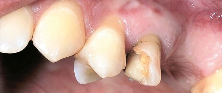 Abb. 8a-e: Sofortimplantation 25 und verzögertes Sofortimplantat regio 26.