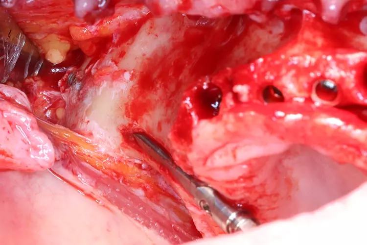 Abb. 9: Zygoma Strauman flat Implantat in situ, bikortikale Verankerung
(Drehmoment über 70 Ncm).