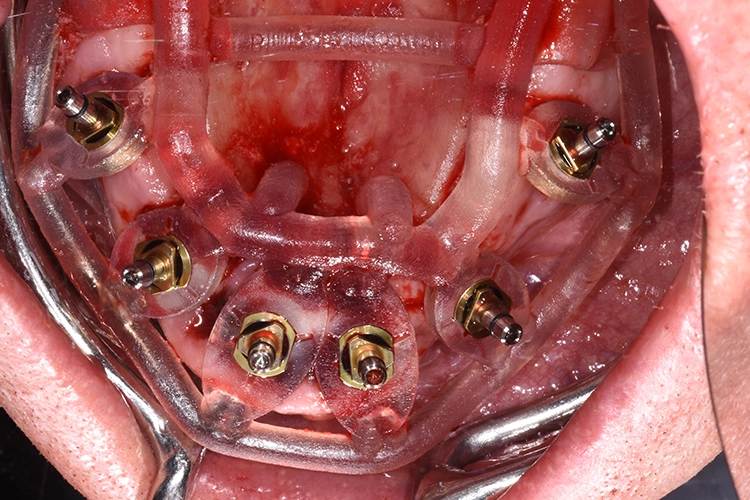 Abb. 9: Implantate in situ.