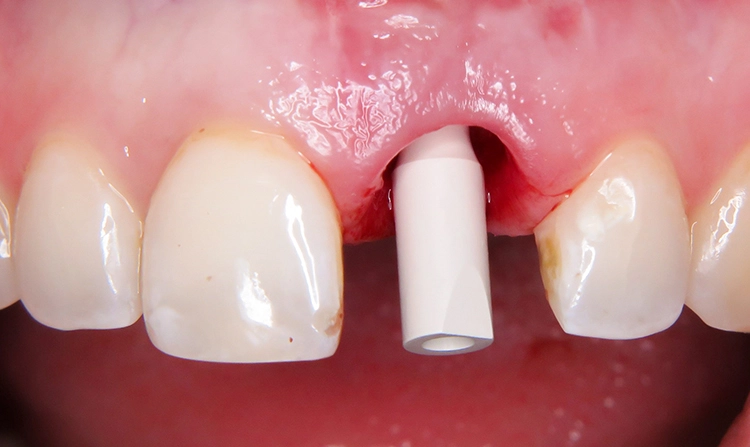 Abb. 9 und 10: Auf das Implantat aufgebrachter Scanbody regio 21 für die direkte Digitalisierung der Situation mit dem Intraoralscanner (Trios 3, 3Shape).