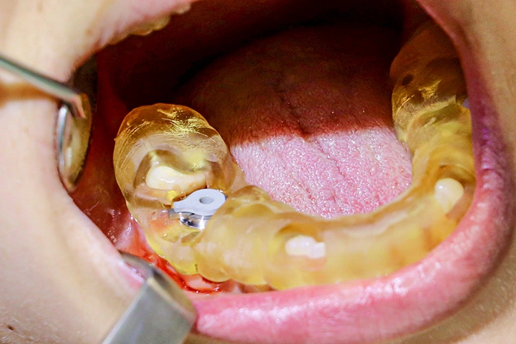 Abb. 9: Die Implantation des Medentika Microcone-Implantates (Ø 5,0 mm x 9 mm) erfolgte vollständig navigiert mittels „Smile-in-a-Box“-Bohrschablone; hier mit Reduzierhülse für die Pilotbohrung.