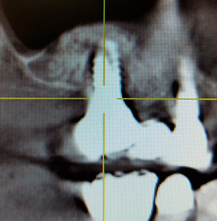 Abb. 9: Röntgenaufnahme Implantat regio 16 mit bereits erkennbaren freiliegenden Gewindegängen.