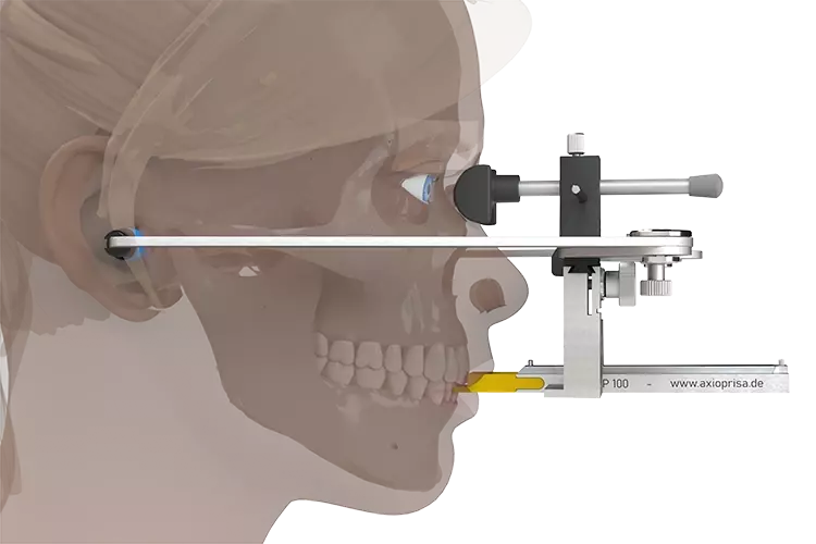 Abb. 4: AxioPrisa – der angelegte herkömmliche Gesichtsbogen AxioQuick mit dem neuen AxioPrisa Bissgabelträger.