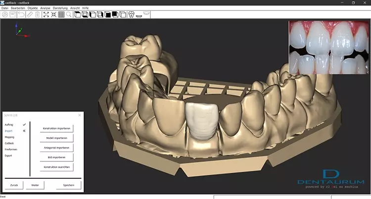 Abb. 7: Vollanatomische Konstruktion durch CAD-Designer/-innen und …