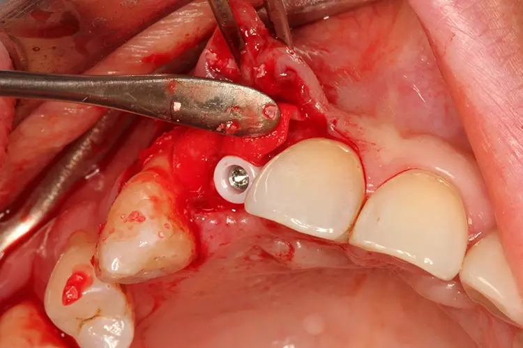 Abb. 10: Augmentation im Bereich des vestibulären Knochens.
