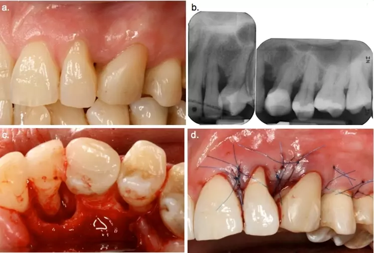 Abb. 10: a) klinische und b) radiologische Ausgangssituation der Zähne 22 bis 25;
c) die intraoperative Ansicht zeigt ausgeprägte vertikale Defekte an den Zähnen
22 und 25; d) der dichte interdentale Wundverschluss wurde durch eine geeignete
Schnittführung im Sinne eines Papillenerhaltungslappens begünstigt.