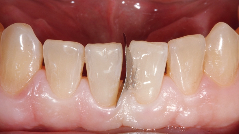 Abb. 11: Verschalung mesial des Zahnes 41.