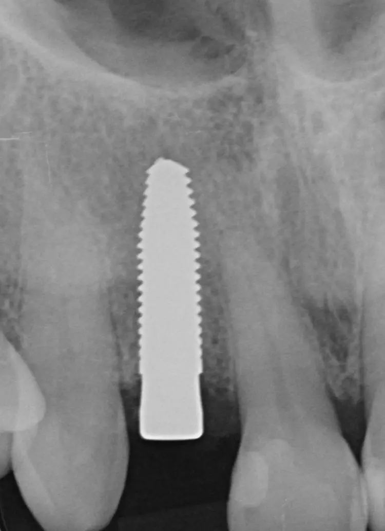 Abb. 11: Die postoperative Röntgenaufnahme
zeigt eine ideale Positionierung
des Implantates.