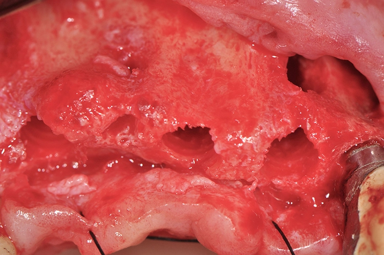 Abb. 11: Final aufbereitetes Implantatbett.