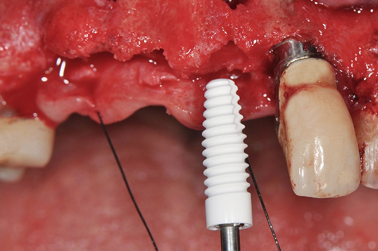 Abb. 12: Insertion NobelPearl-Implantat neben bestehendem Titanimplantat.