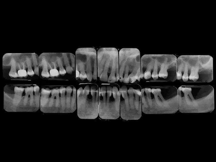 Abb. 13: Der Röntgenstatus 4 Jahre nach Therapiebeginn zeigt weitgehend stabile parodontale Verhältnisse im Sinne von kortikalisierten Interdentalsepten. Das kieferorthopädische
Therapieergebnis wurde mit einem Retainer von 33 bis 43 gesichert. Im Rahmen der UPT erfolgt regelmäßig auch eine kieferorthopädische Nachsorge.