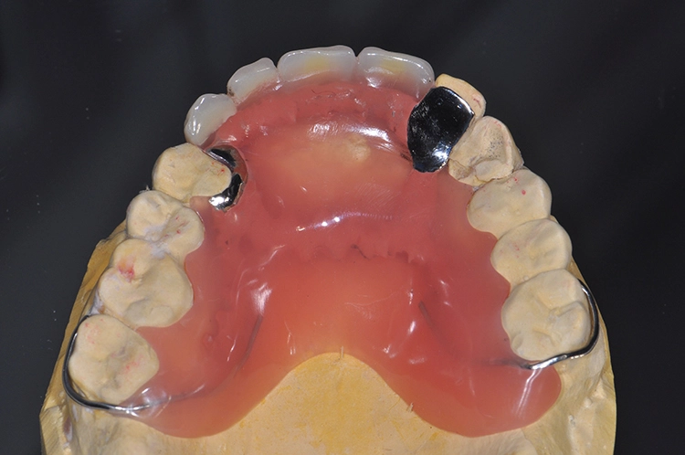 Abb. 19: Interimsprothese mit Abstützung.