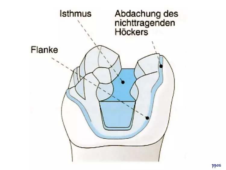 Abb. 1: Schemadarstellung der Präparation für eine gegossene Teilkrone aus EM; aus: Lehmann/Hellwig: Zahnärztliche Propädeutik, DÄV 2016.