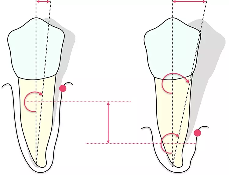 Abb. 1: Illustration der Zahnbeweglichkeit bei gesundem Parodont (links) und
reduziertem Attachment (rechts). Die in Höhe der Okklusionsebene gemessene
Auslenkung ist infolge der Apikalverschiebung des Widerstandszentrums erhöht.