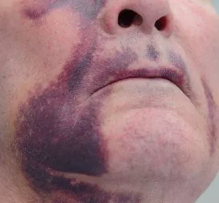 Abb. 1: Antikoagulierter Patient vier Tage post OP mit ausgeprägtem Hämatom.