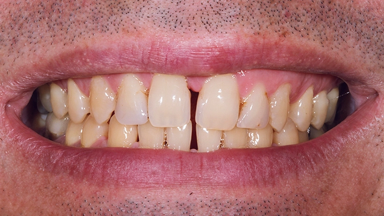 Abb. 1: 48-jähriger Patient mit auffälligem Diastema mediale im Ober- und im Unterkiefer.